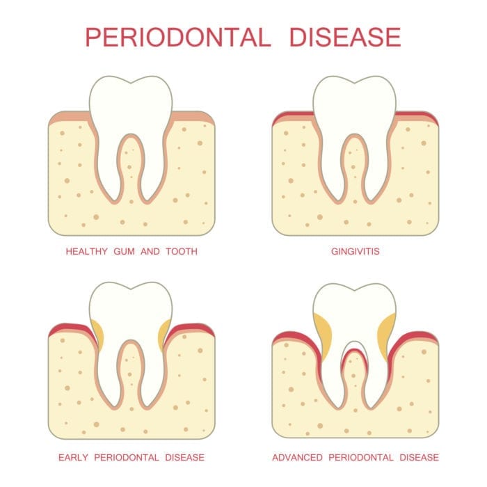 periodontal therapy indianapolis in
