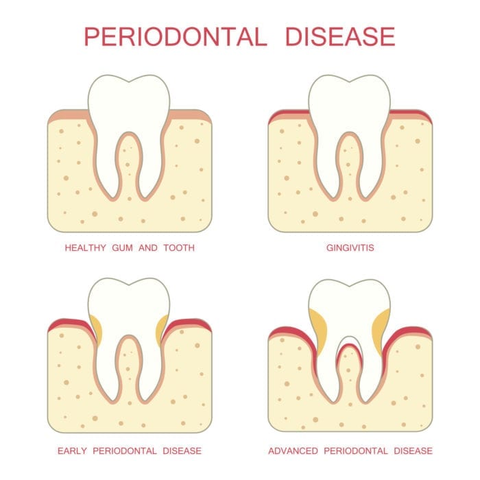 periodontal therapy indianapolis in