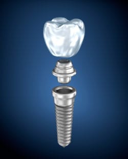 dental implants indianapolis in
