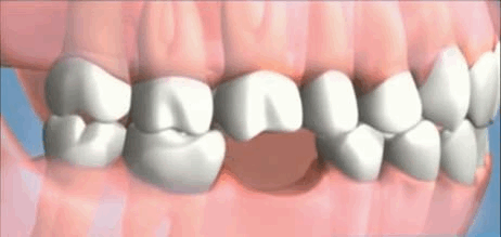 Missing teeth can cause more issues